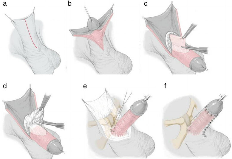 ligamentotómia na zväčšenie penisu